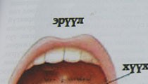 Гүйлсэн булчирхайн үрэвсэл буюу ангинатах 