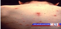  Цэврүүт тууралтат хам шинжийн гаралт буурчээ 