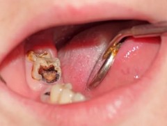 Тав хүртэлх насны хүүхдүүдийн 88 хувь нь шүдний өвчтэй байна