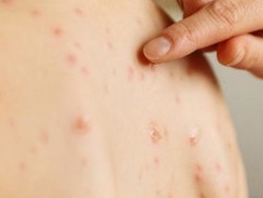 ХӨСҮТ: Улаанбурхан өвчний батлагдсан тохиолдол 1789 болжээ