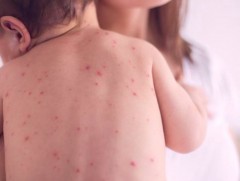  ХӨСҮТ: Улаанбурхан өвчний батлагдсан тохиолдол 8  нэмэгджээ