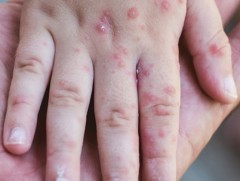 Орон нутагт улаанбурхан өвчний 2 тохиолдол батлагдав