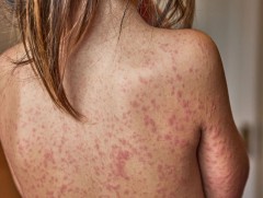 Бангладешт улаанбурхны халдварын улмаас 100 гаруй хүүхэд энджээ 